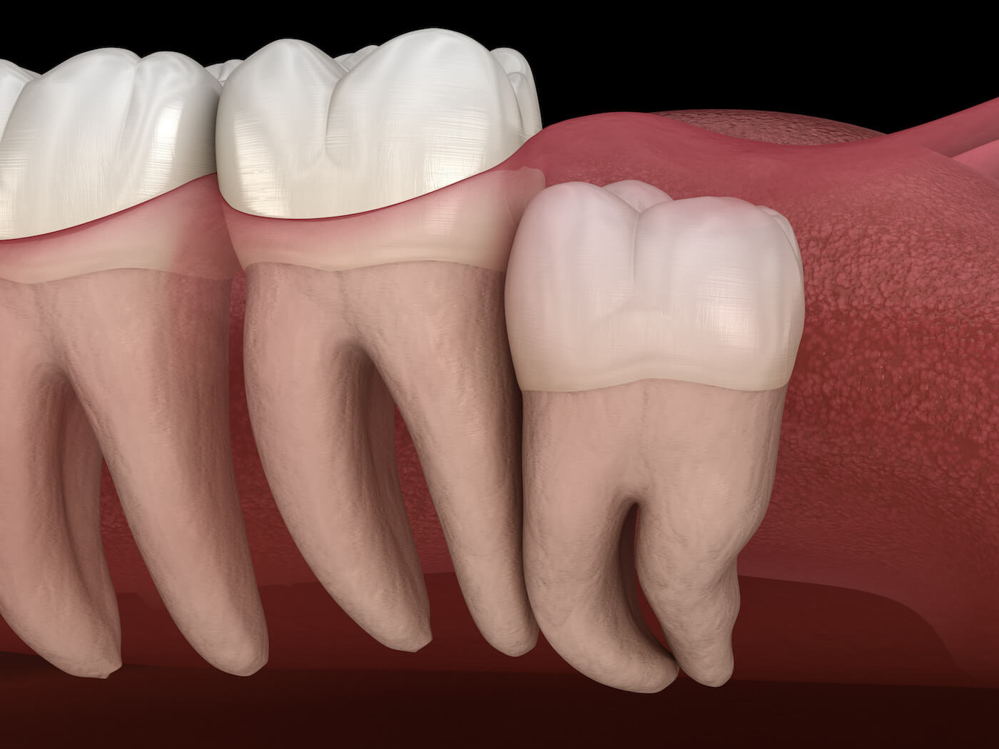 Wisdom Teeth Removal in Parker, AZ | Parker Dental Center